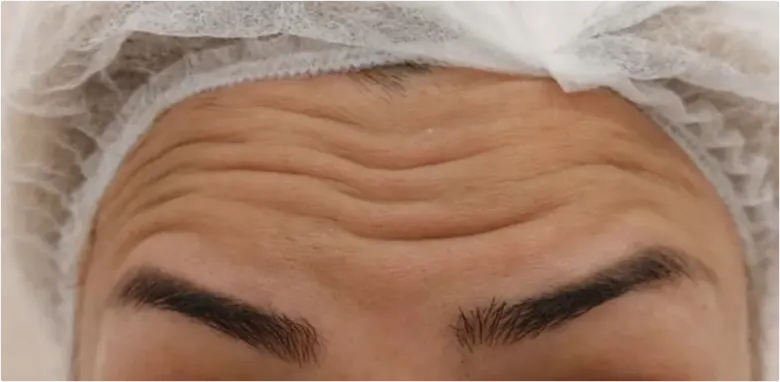 Before and After Anti Wrinkle Injections Coventry