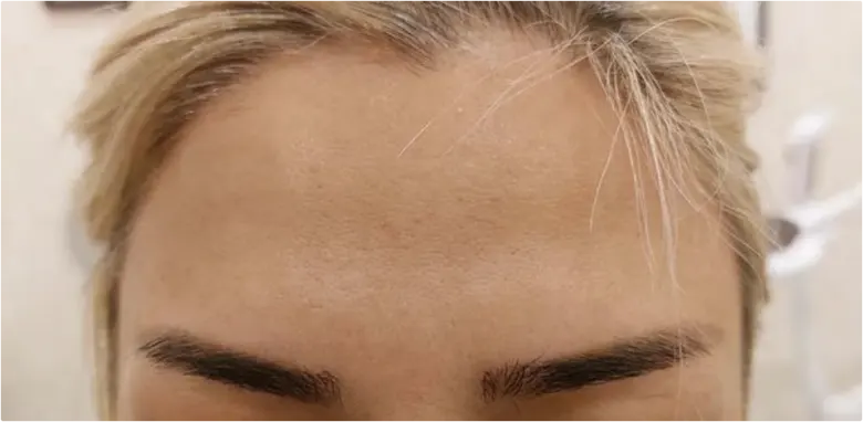 Forehead Wrinkle Treatment Before and After Coventry