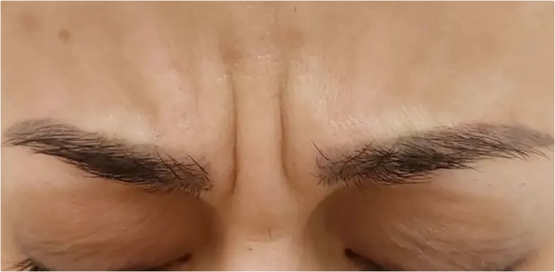 Anti Wrinkle Injections Results Rugby