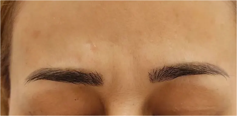 anti-wrinkle injections before and after rugby