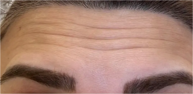 Anti Wrinkle Injections Results Rugby