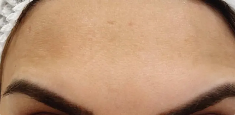 “Before and after Botox treatment for forehead lines”